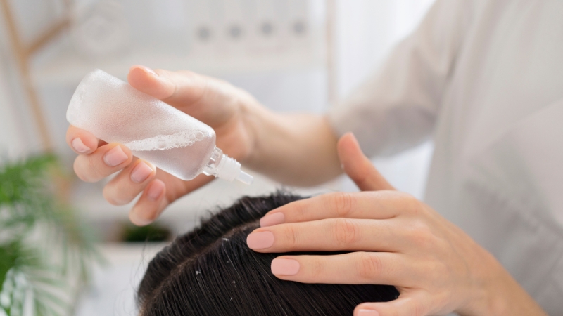 Person applying a natural antifungal scalp treatment to reduce flakes and control Malassezia yeast growth
