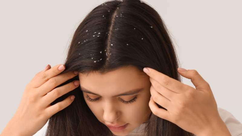 Woman examining visible dandruff on her scalp, a common sign of Malassezia overgrowth linked to skin and lifestyle factors