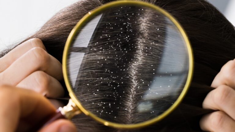 Magnified view of scalp flakes caused by Malassezia Yeast overgrowth